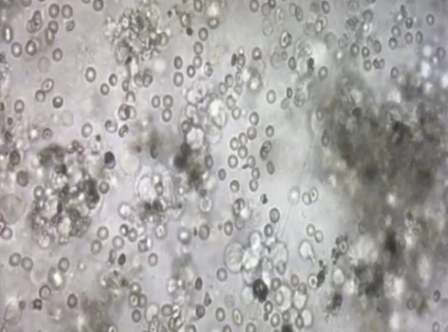 Χειρουργική λήψη σπέρματος (TESE/ micro- TESE) Δρ Ελπίδα Βαρουχάκη Ηράκλειο Κρήτης