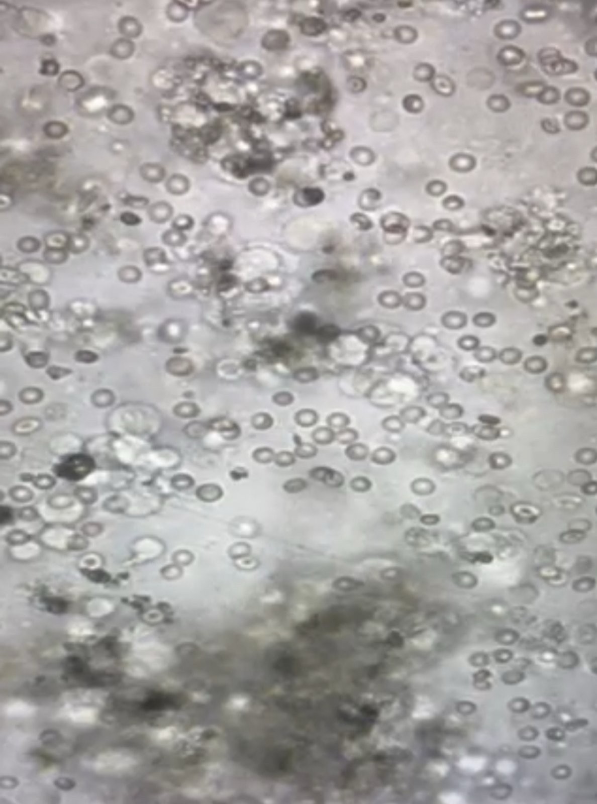 Χειρουργική λήψη σπέρματος (TESE/ micro- TESE) Ελπίδα Βαρουχάκη Ηράκλειο Κρήτης